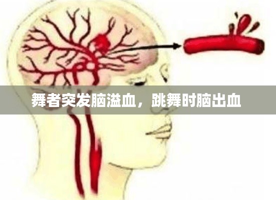 舞者突發(fā)腦溢血，跳舞時(shí)腦出血 
